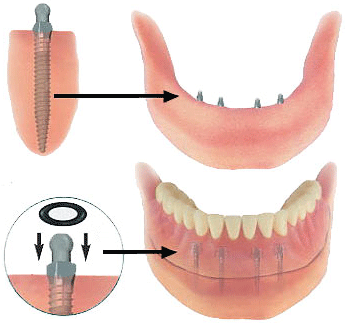 estabilizando-dentadura-con-mini-implante